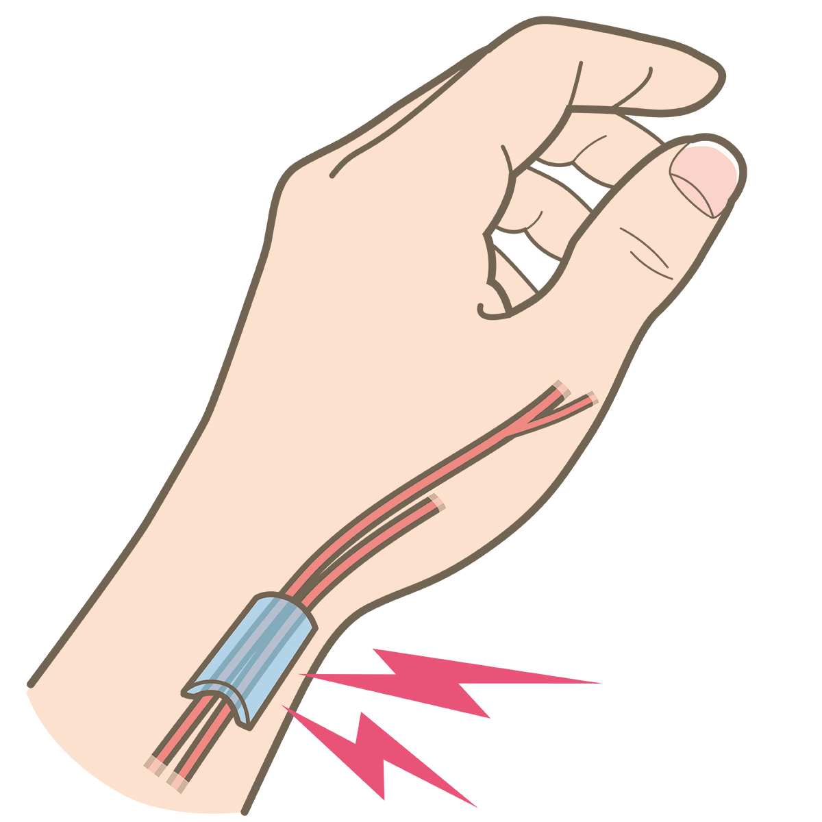 腱鞘炎の原因