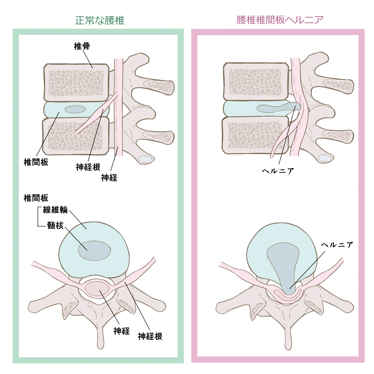 腰椎椎間板ヘルニア